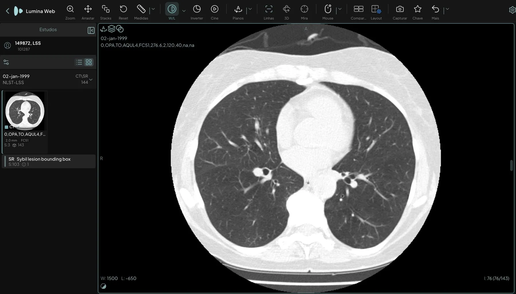 Visualizador web do Lumina PACS com uma tomografia de tórax do acervo público de-identificado, painel de estudos à esquerda e barra de ferramentas no topo