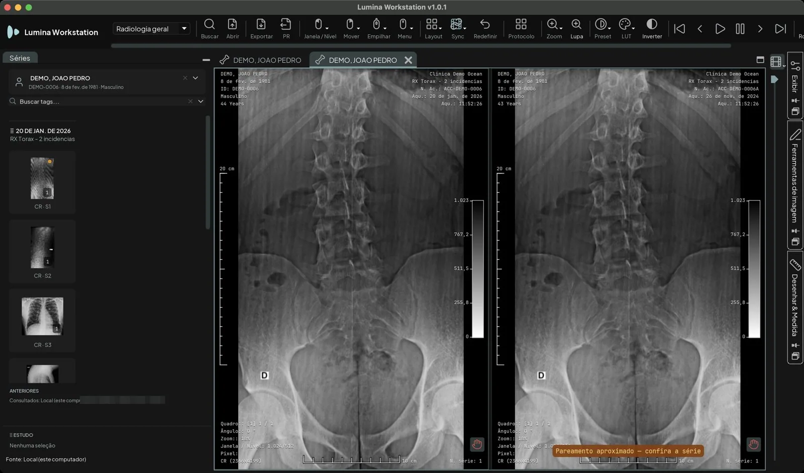 Lumina Workstation com o RX de coluna lombar atual e o anterior lado a lado e o aviso Pareamento aproximado, confira a série, sobre a imagem da direita