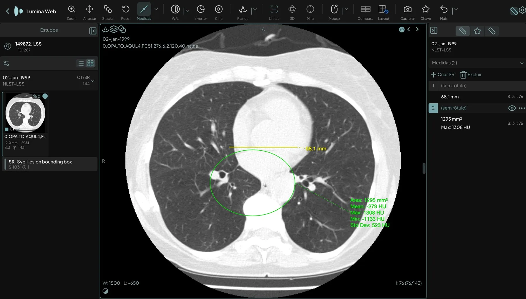 TC de tórax com uma medida de comprimento de 68,1 mm e uma região de interesse elíptica com área, média, máximo, mínimo e desvio padrão em HU escritos na imagem; painel de medidas aberto à direita com os botões de gravar no exame e Excluir