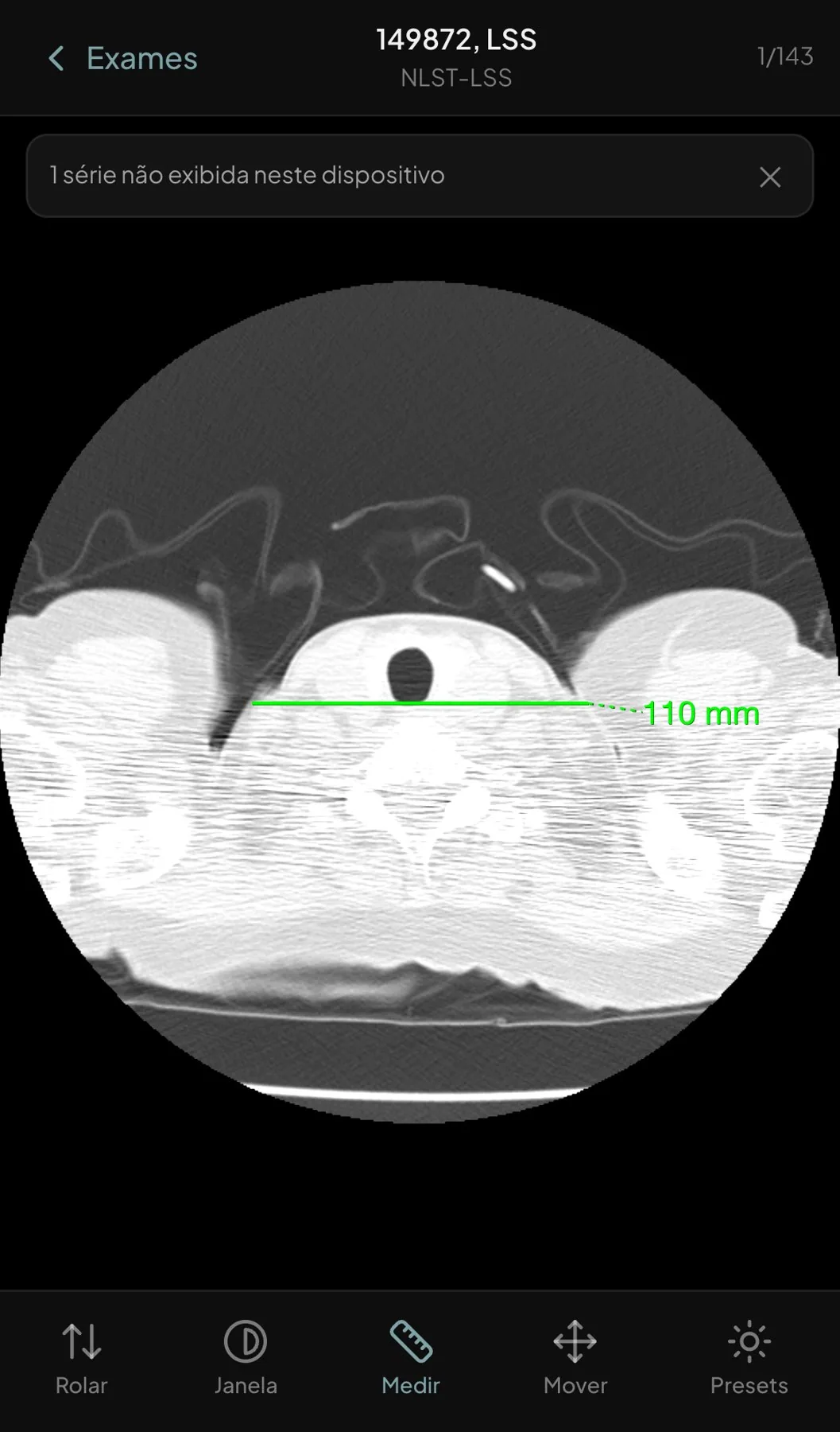 Medição de comprimento de 110 mm feita com um dedo numa TC de tórax no celular, com a ferramenta Medir ativa na barra inferior