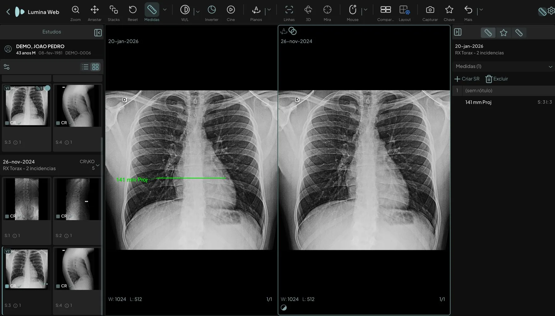 Lumina Web no navegador com dois raios X de tórax lado a lado: à esquerda o exame atual, com a data no canto e uma medida de 141 milímetros traçada sobre a imagem; à direita o exame anterior, de mais de um ano antes, com a sua data; no painel lateral, a lista de medidas do exame atual