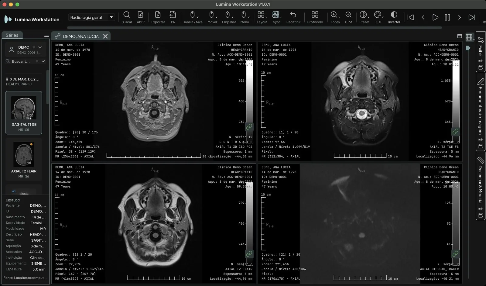 Janela principal da Lumina Workstation com o explorador de séries à esquerda, a ficha do estudo e o visualizador em 2x2 montado pelo protocolo de tela: T1, T2 FLAIR, T2 e difusão de uma RM de crânio de paciente fictício