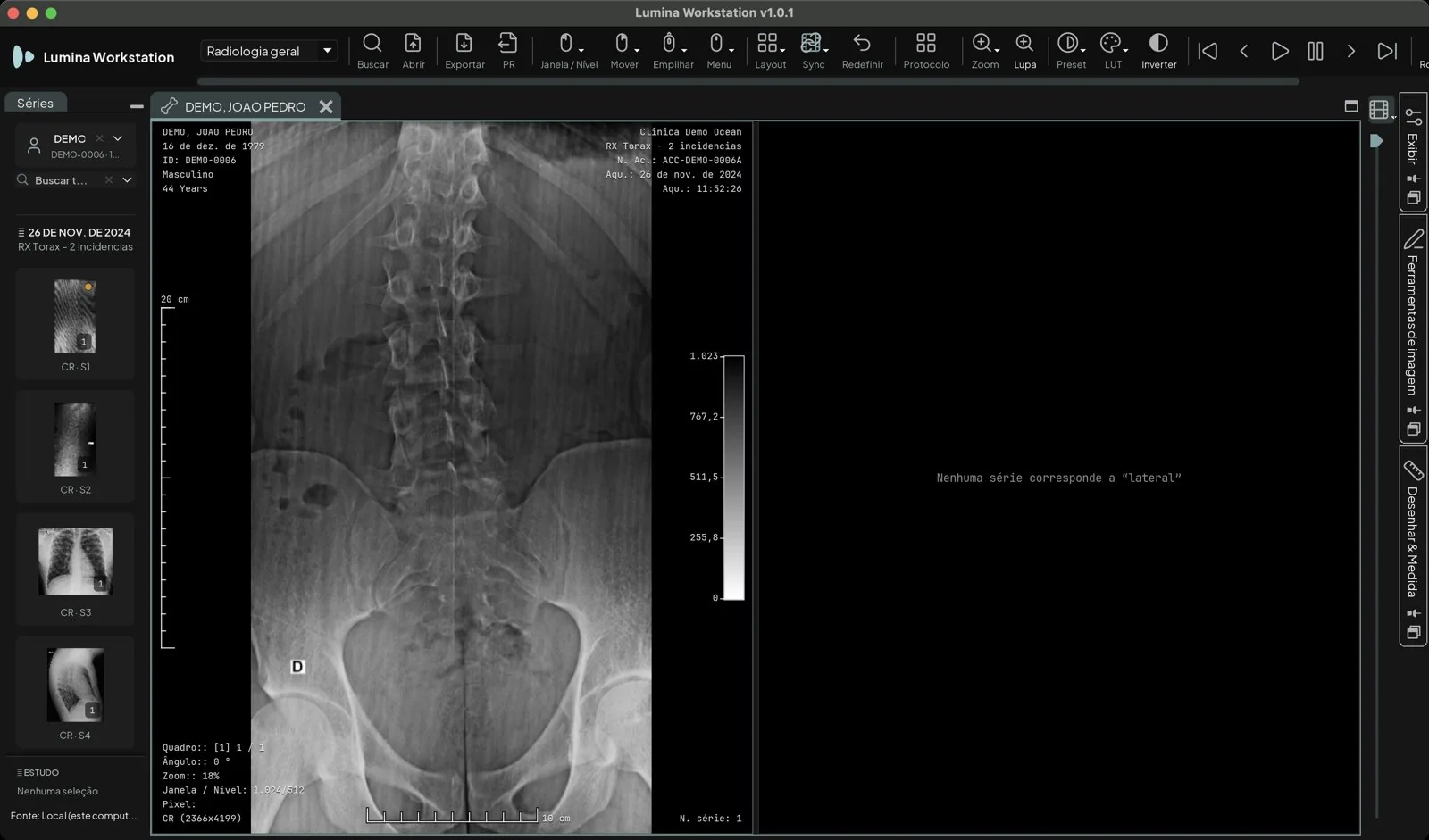 Protocolo de tela aplicado a um RX com a incidência frontal à esquerda e a janela da direita vazia com a mensagem Nenhuma série corresponde a lateral