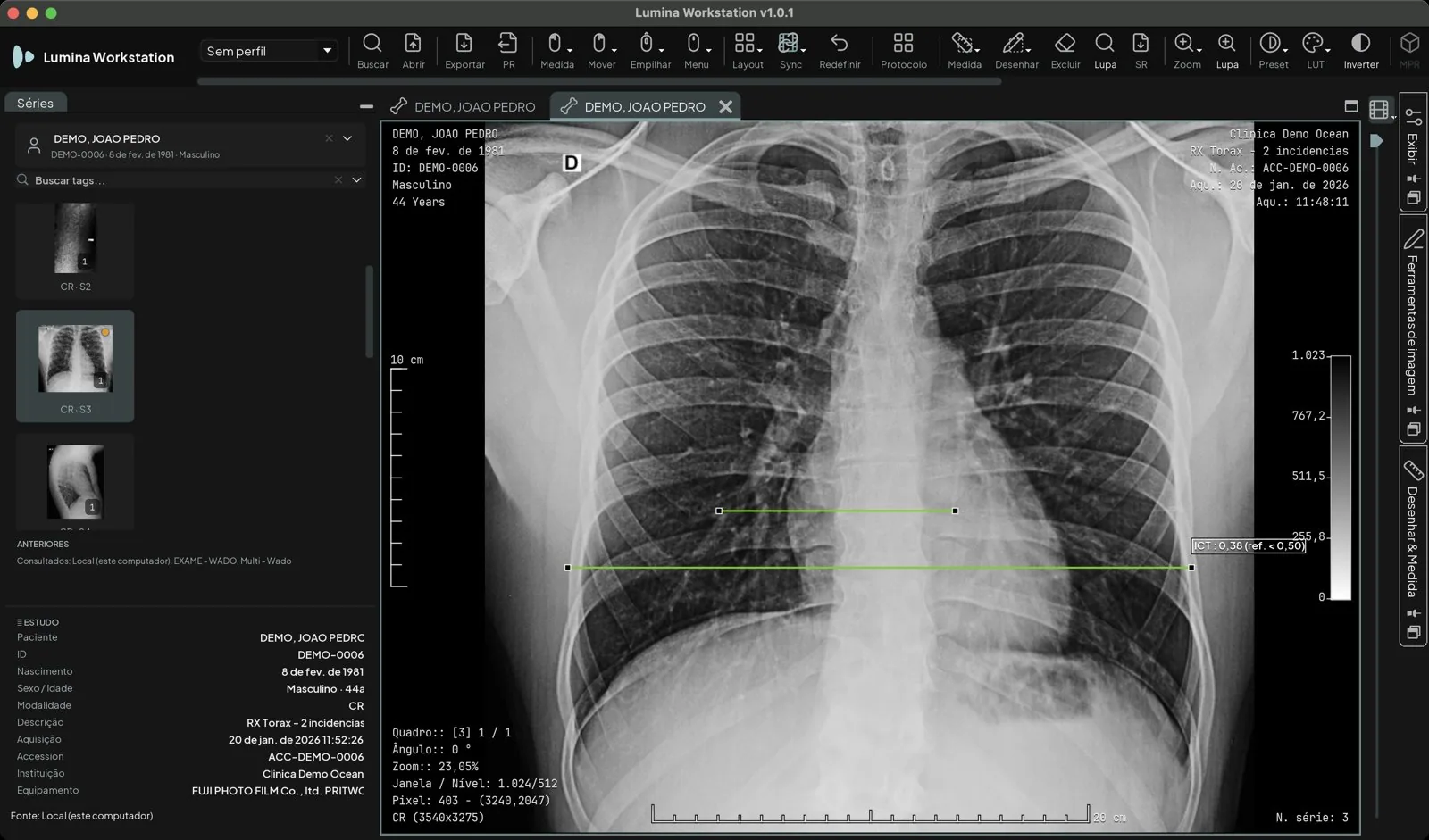 Radiografia de tórax com a medição clínica de índice cardiotorácico: duas linhas verdes, a cardíaca e a torácica, e a etiqueta ICT: 0,38 (ref. < 0,50)